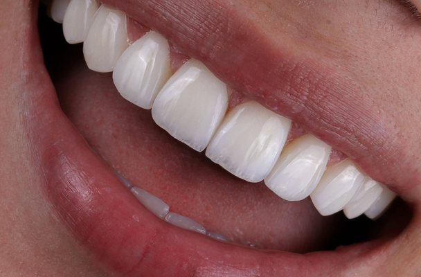 RĂNG SỨ THẨM MỸ